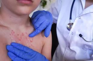 UYUZ VAKALARINDA ARTIŞ